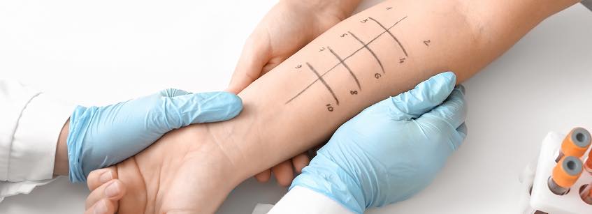 alergia prick test